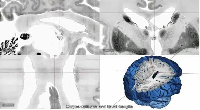 Crean el mapa 3D del cerebro humano con una resolución microscópica jamás lograda