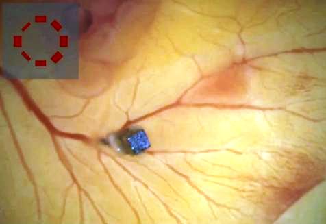Micro-robots realizan cirugías oculares, sin incisiones