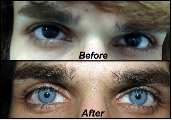 Procedimiento quirúrgico controvertido puede cambiar el color de los ojos permanentemente