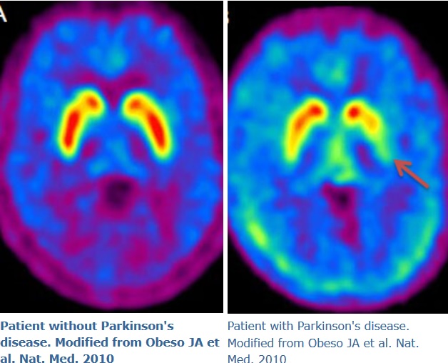 Una droga utilizada para tratar el hígado podría ser la clave en la cura del Parkinson