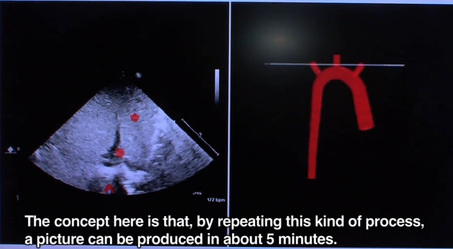Modelamiento 3D para mostrar condiciones cardíacas congénitas