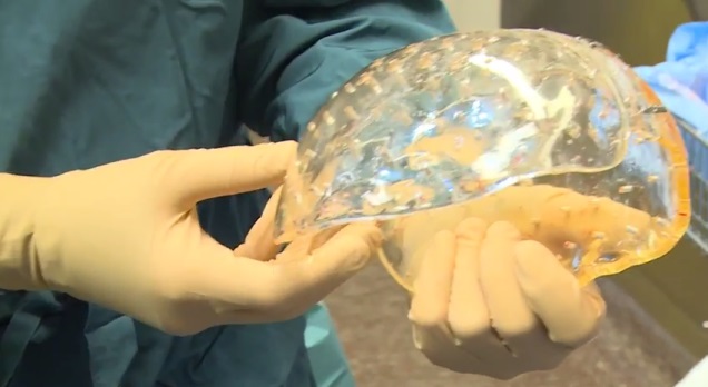 Vea cómo le implantan un cráneo impreso en 3D a una mujer