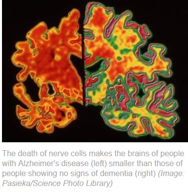 Análisis de sangre podría detectar el Alzheimer 3 años antes que aparezca