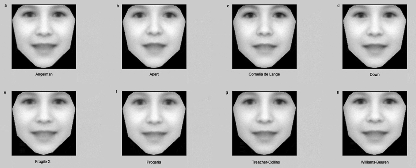 Software detecta enfermedades genéticas raras a partir de fotos