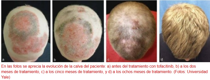 Descubren tratamiento eficaz contra la alopecia universal