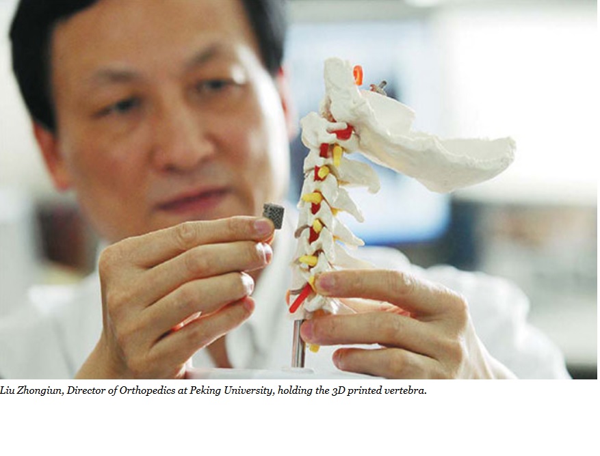 Han implantado la primera vértebra impresa 3D en un niño de 12 años de edad