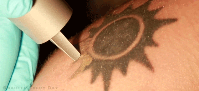 En video cómo funciona el proceso de quitar un tatuaje con láser