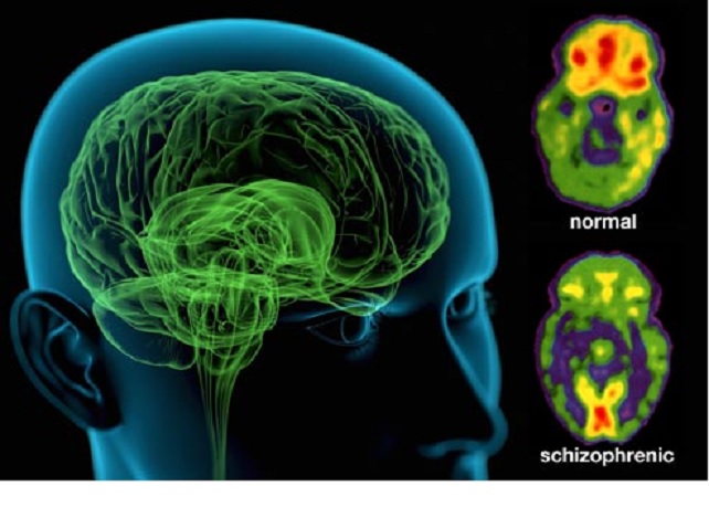 Científicos han hallado finalmente un proceso biológico detrás de la esquizofrenia
