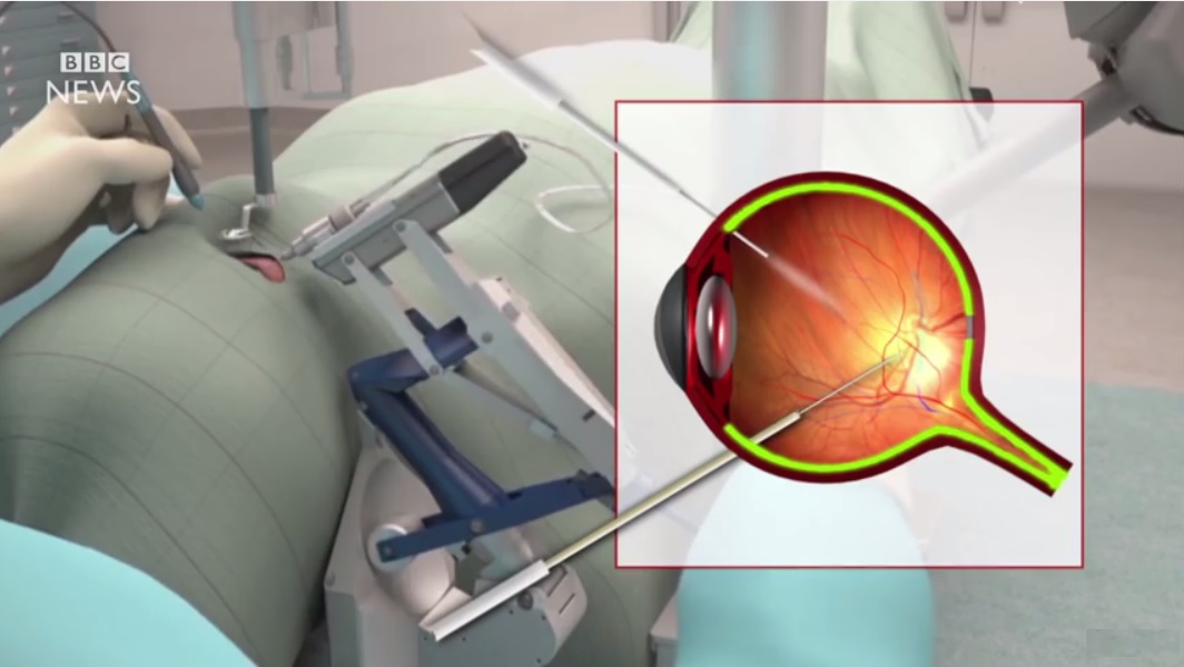 Ahora los robots pueden realizar cirugías dentro de sus ojos