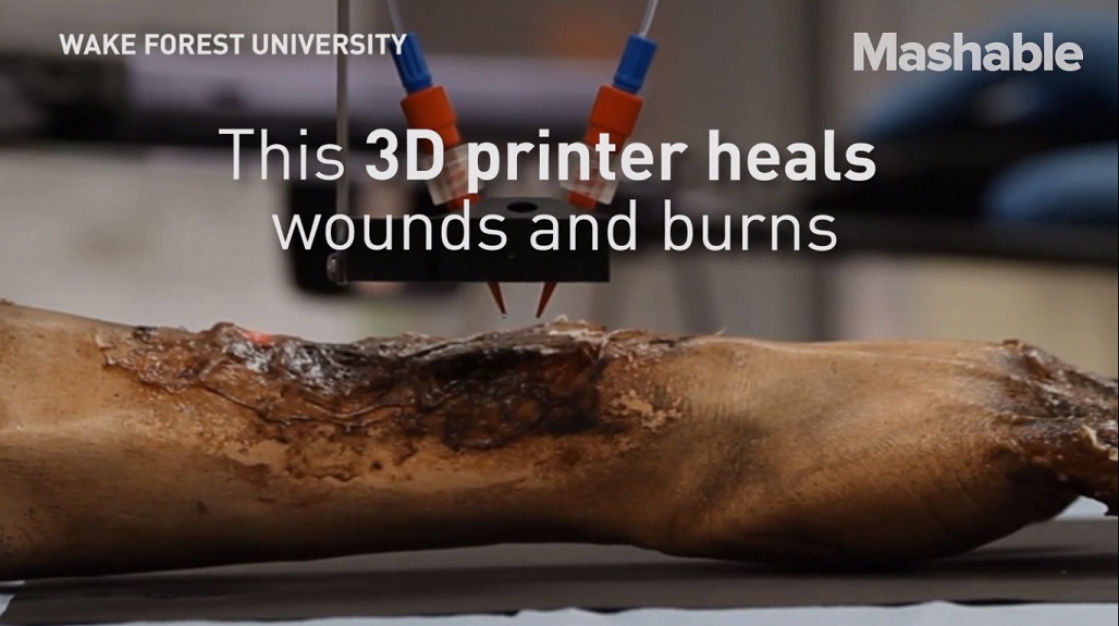 Quemaduras pueden sanar más rápido con una impresora de piel 3D