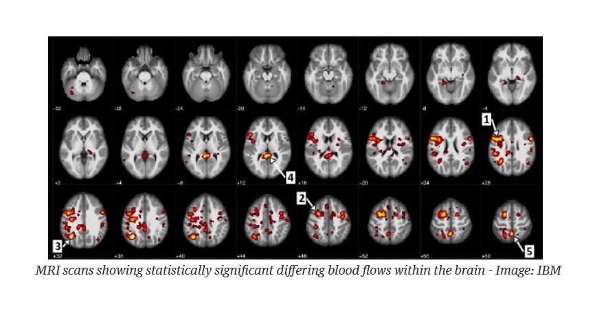 Inteligencia artificial puede predecir la esquizofrenia observando el flujo sanguíneo del cerebro