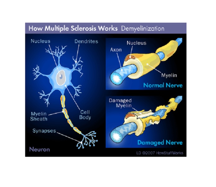 Revierten la esclerosis múltiple avanzada en ratones