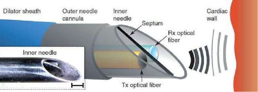 Crean una aguja de ultrasonido para obtener imágenes quirúrgicas internas