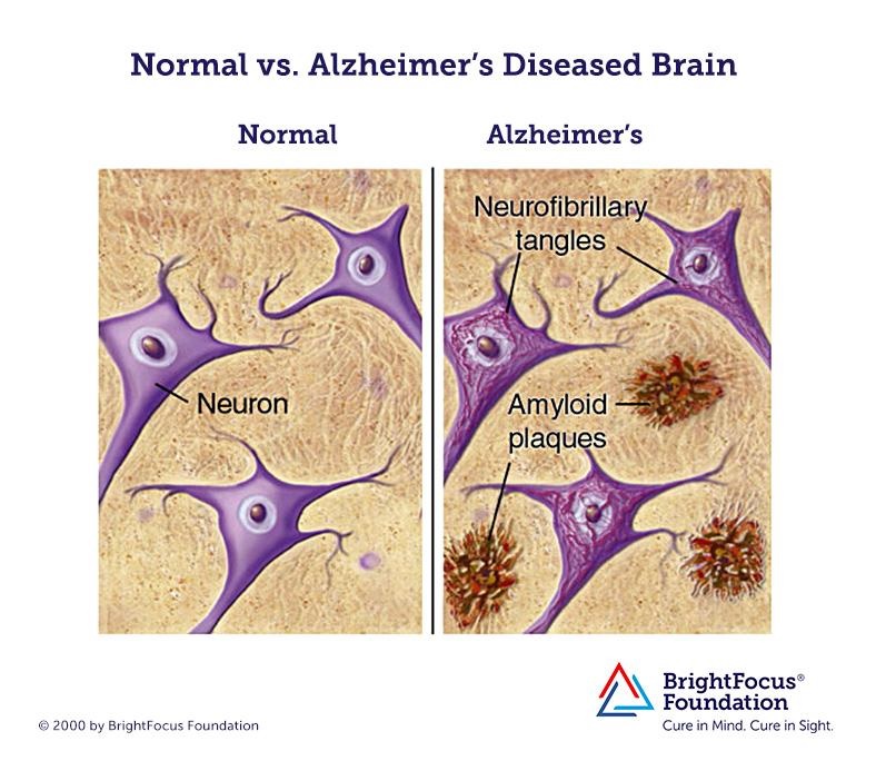 Reducen el daño cerebral del alzhéimer con un nuevo compuesto
