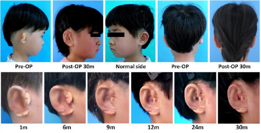Han usado una impresora 3D para crear orejas en niños