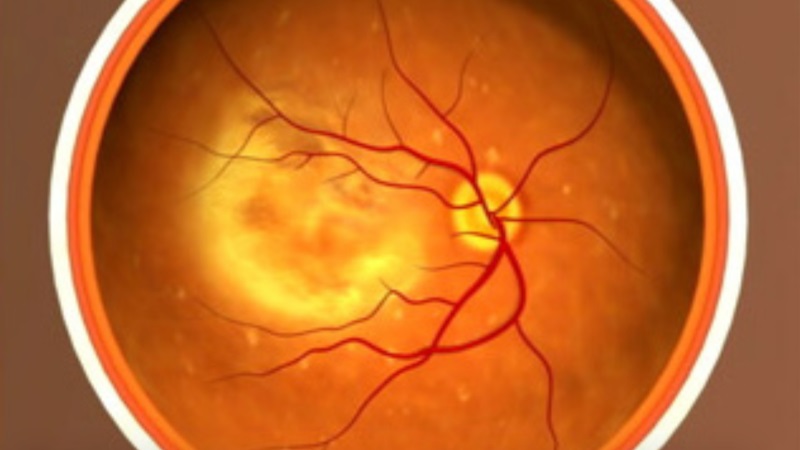 Usan células madre para restaurar la vista en dos personas con degeneración macular