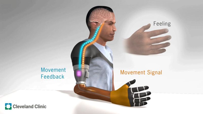 Crean una forma para que personas con amputaciones sientan sus manos protésicas