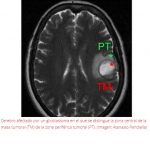 IMPIDEN EN RATONES LA PROGRESIÓN DEL GLIOBLASTOMA, EL TUMOR CEREBRAL MÁS AGRESIVO