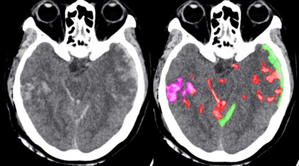 INTELIGENCIA ARTIFICIAL PUEDE AYUDAR A LOS MÉDICOS A DETECTAR HEMORRAGIAS CEREBRALES MÁS RÁPIDO