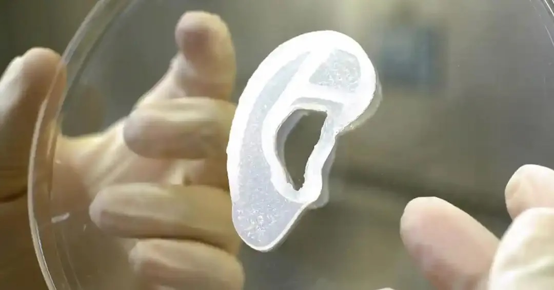 Trasplantan una oreja impresa en 3D con las propias células de la paciente