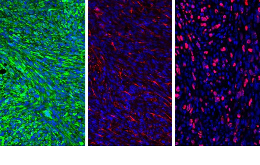 Nanopartícula e inhibidor activan el sistema inmune en nueva estrategia para atacar al cáncer cerebral
