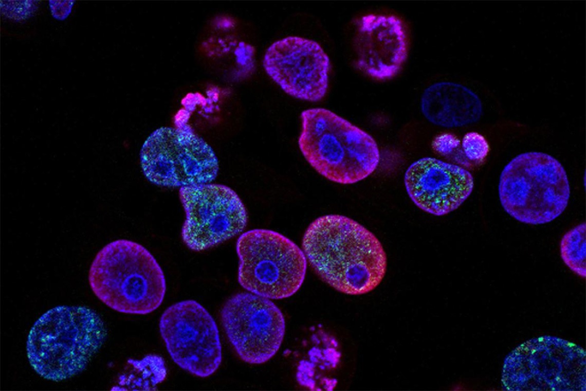 Terapia fotodinámica destruye células cancerosas resistentes a la quimioterapia