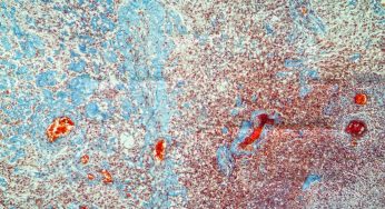 Inteligencia artificial revela cómo el sistema de defensa del cuerpo reconoce el cáncer de piel