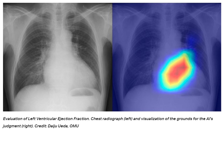 Inteligencia artificial utiliza radiografías de tórax para detectar enfermedades del corazón con una precisión sin precedentes