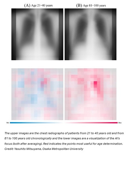Inteligencia artificial utiliza radiografías de tórax para saber su edad