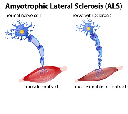 Nueva terapia para reducir la muerte neuronal en la esclerosis lateral amiotrófica