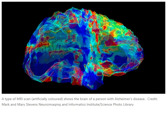 Inteligencia artificial detecta la enfermedad de Alzheimer con una precisión de más del 90%
