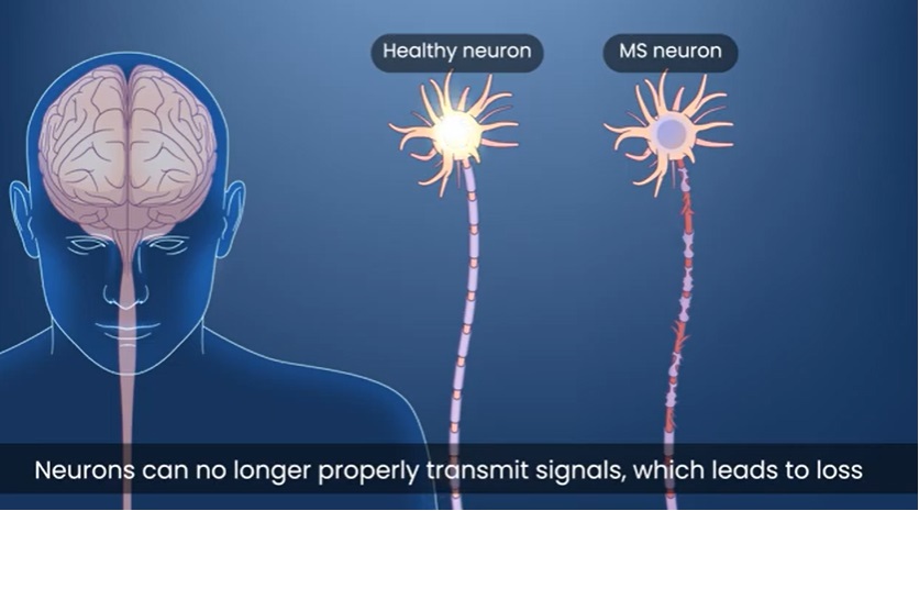 Tratamiento para la esclerosis múltiple da muy buenos resultados en pacientes en fase avanzada