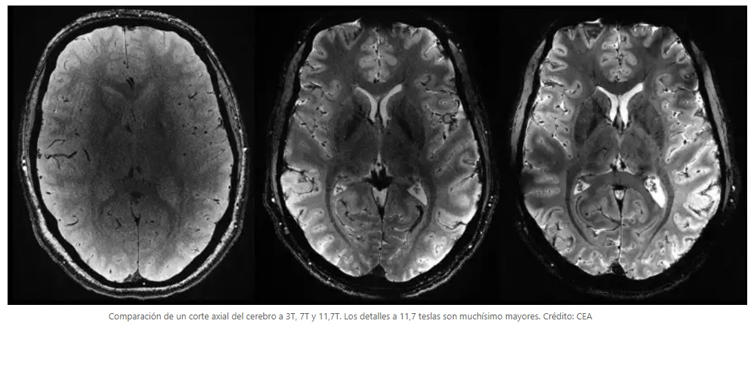 Logran la resonancia magnética del cerebro más potente, con imágenes 10 veces más precisas